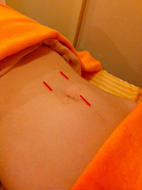 鍼について